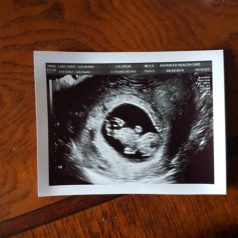 fake ultrasound pictures